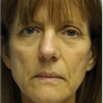Fat Grafting Before & After Patient #5195