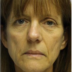 Fat Grafting Before & After Patient #5195