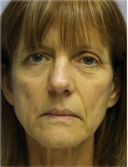 Fat Grafting Before & After Patient #5195