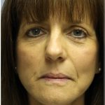Fat Grafting Before & After Patient #5195