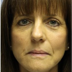 Fat Grafting Before & After Patient #5195