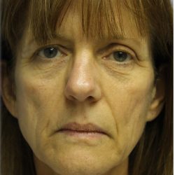 QuickLift Before & After Patient #5697