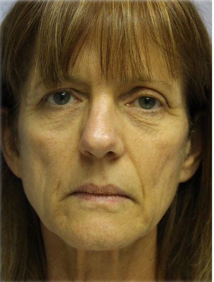 QuickLift Before & After Patient #5697
