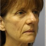 Fat Grafting Before & After Patient #5195