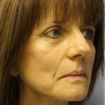 Fat Grafting Before & After Patient #5195