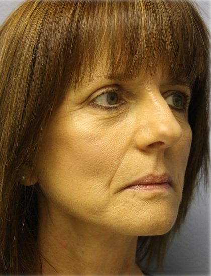 Fat Grafting Before & After Patient #5195