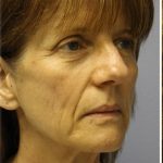 QuickLift Before & After Patient #5697