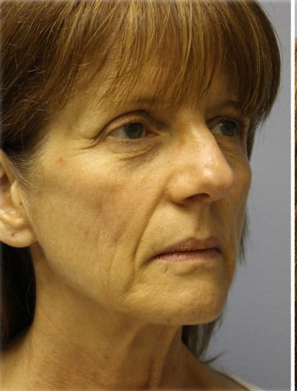 QuickLift Before & After Patient #5697