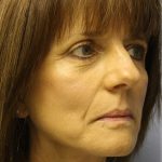 QuickLift Before & After Patient #5697