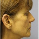 Fat Grafting Before & After Patient #5195