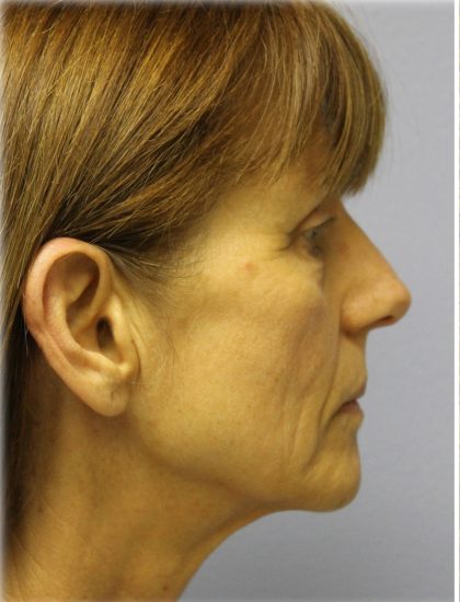 Fat Grafting Before & After Patient #5195