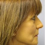 Fat Grafting Before & After Patient #5195
