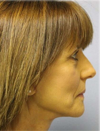 Fat Grafting Before & After Patient #5195