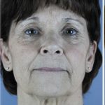 QuickLift Before & After Patient #5633