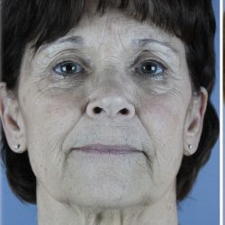 QuickLift Before & After Patient #5633