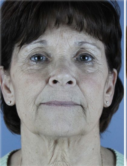 QuickLift Before & After Patient #5633