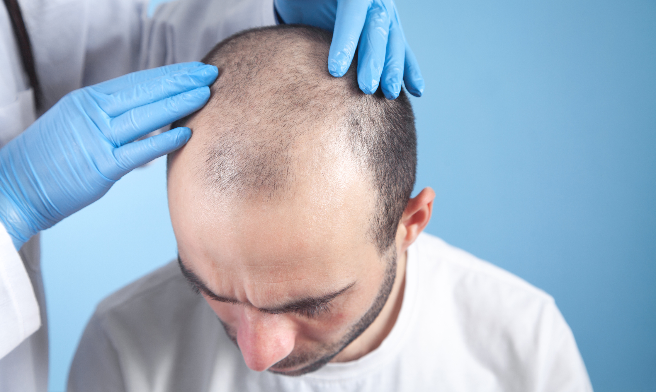 The Evolution of Hair Transplant Techniques: From FUT to FUE | Vargas Face  & Skin Center