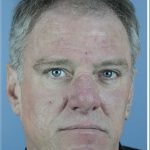 Hair Transplant Before & After Patient #6262