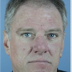Hair Transplant Before & After Patient #6262
