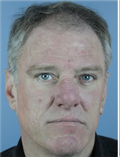 Hair Transplant Before & After Patient #6262