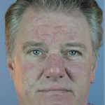 Hair Transplant Before & After Patient #6262