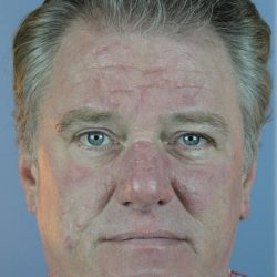 Hair Transplant Before & After Patient #6262