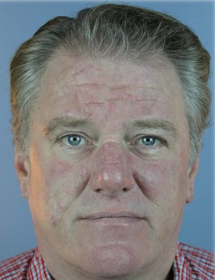 Hair Transplant Before & After Patient #6262
