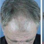 Hair Transplant Before & After Patient #6262