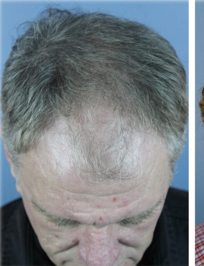 Hair Transplant Before & After Patient #6262