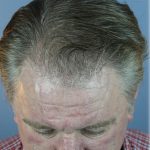 Hair Transplant Before & After Patient #6262