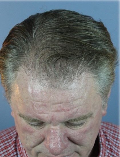 Hair Transplant Before & After Patient #6262