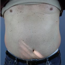 Laser Lipo Before & After Patient #6263