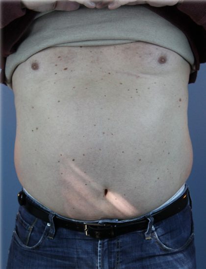 Laser Lipo Before & After Patient #6263