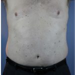 Laser Lipo Before & After Patient #6263