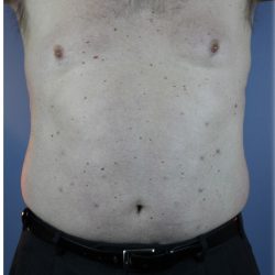 Laser Lipo Before & After Patient #6263