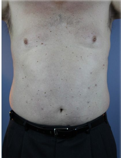 Laser Lipo Before & After Patient #6263