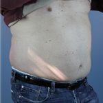 Laser Lipo Before & After Patient #6263