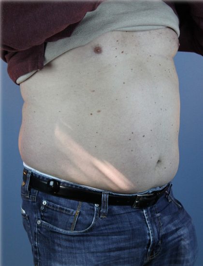 Laser Lipo Before & After Patient #6263