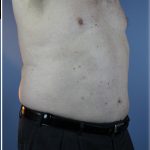 Laser Lipo Before & After Patient #6263