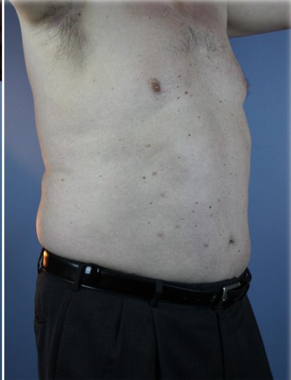 Laser Lipo Before & After Patient #6263