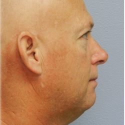 Neck Liposuction Before & After Patient #6264