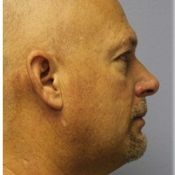 Neck Liposuction Before & After Patient #6264