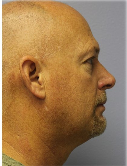 Neck Liposuction Before & After Patient #6264
