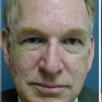 Broad Band Light Before & After Patient #6265