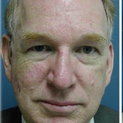 Broad Band Light Before & After Patient #6265