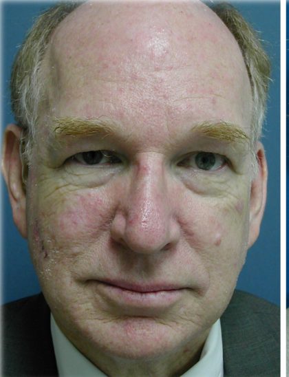 Broad Band Light Before & After Patient #6265