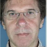 Broad Band Light Before & After Patient #6267
