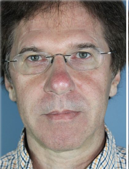 Broad Band Light Before & After Patient #6267