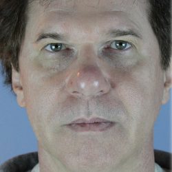 Broad Band Light Before & After Patient #6267