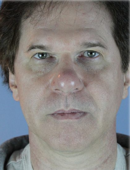 Broad Band Light Before & After Patient #6267